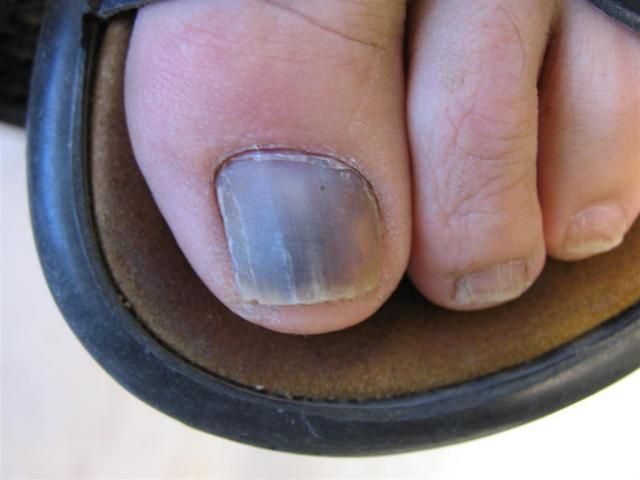 NAIL DISEASES - Onychomycosis NAIL DISEASES - Onychomycosis