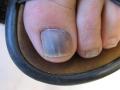 NAIL DISEASES - Onychomycosis