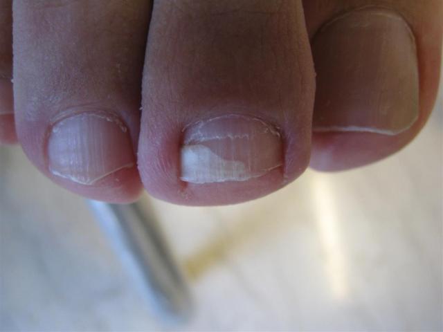 NAIL DISEASES - Onychomycosis