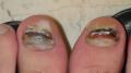 NAIL DISEASES - Onychomycosis