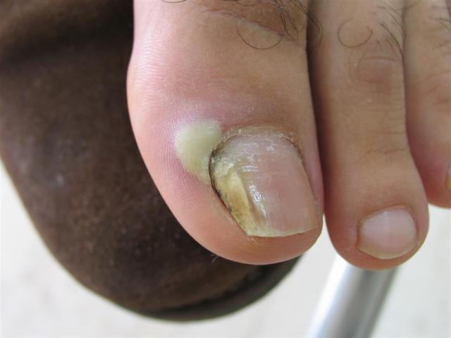 NAIL DISEASES - Onychomycosis