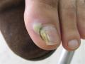 NAIL DISEASES - Onychomycosis