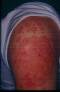 DERMATITIS - EKZEMA - Allergic Contact Dermatitis