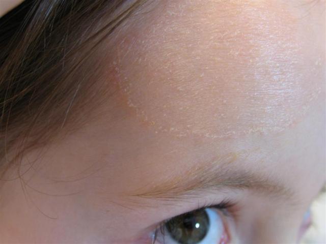 SUPERFICIAL FUNGAL INFECTIONS - Tinea faciale