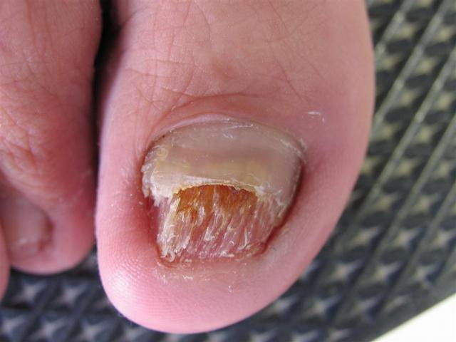 NAIL DISEASES - Onychomycosis