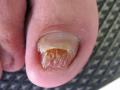 NAIL DISEASES - Onychomycosis