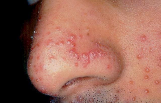 VARIOUS or of UNKNOWN ETIOLOGY DISEASES - Lupus Miliaris Disseminatus Faciei