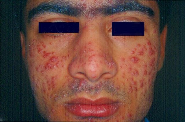 VARIOUS or of UNKNOWN ETIOLOGY DISEASES - Lupus Miliaris Disseminatus Faciei