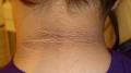 METABOLIC DISEASE, NUTRITION - Acanthosis Nigricans