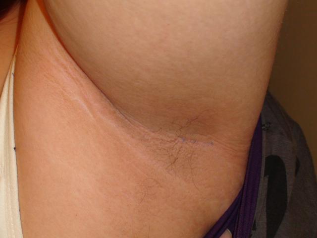 METABOLIC DISEASE, NUTRITION - Acanthosis Nigricans METABOLIC DISEASE, NUTRITION - Acanthosis Nigricans