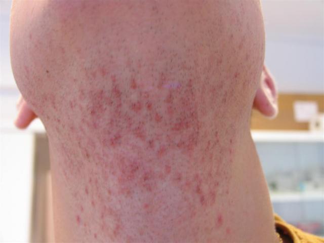 HAIR DISEASES - Pseudofolliculitis barbae HAIR DISEASES - Pseudofolliculitis barbae
