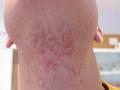 HAIR DISEASES - Pseudofolliculitis barbae