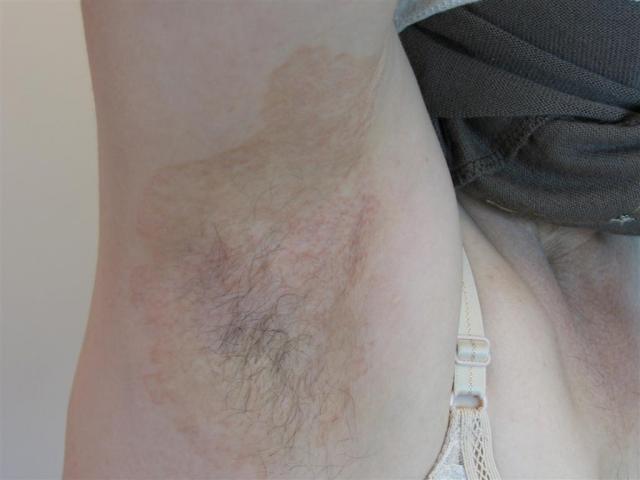 SUPERFICIAL FUNGAL INFECTIONS - Tinea infection