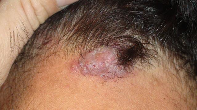 DISEASES OF THE SEBACEOUS GLANDS - Acne cheloidalis DISEASES OF THE SEBACEOUS GLANDS - Acne cheloidalis