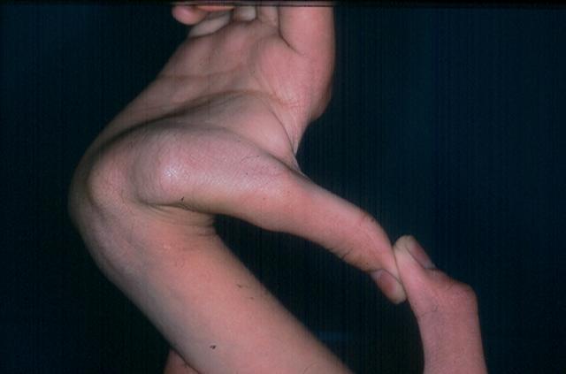 GENODERMATOSES - Ehlers - Danlos syndrome