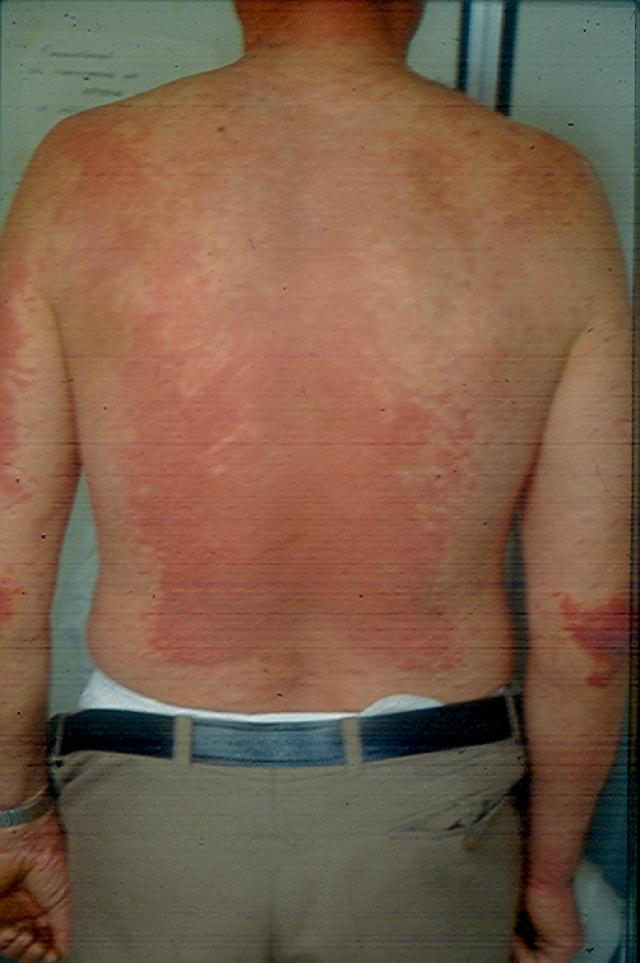 DRUG ERUPTIONS - Drug exanthem due to Bezafibrate DRUG ERUPTIONS - Drug exanthem due to Bezafibrate