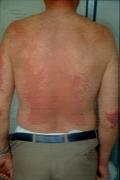 DRUG ERUPTIONS - Drug exanthem due to Bezafibrate