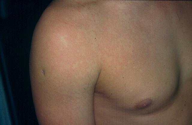 VIRAL INFECTIONS - Erythema Infectiosum VIRAL INFECTIONS - Erythema Infectiosum