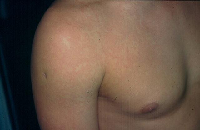 VIRAL INFECTIONS - Erythema Infectiosum