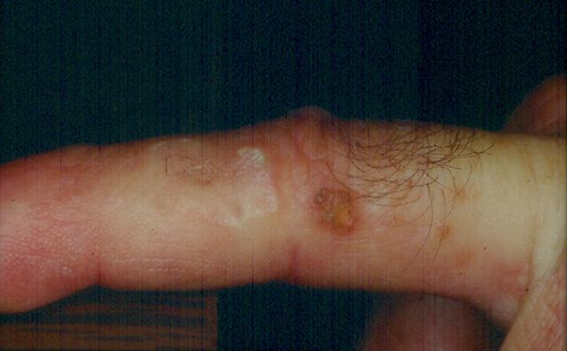 GENODERMATOSES - Epidermodysplasia Verruciformis (Lewandowsky-Lutz dysplasia)