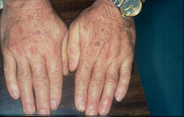 GENODERMATOSES - Epidermodysplasia Verruciformis (Lewandowsky-Lutz dysplasia)