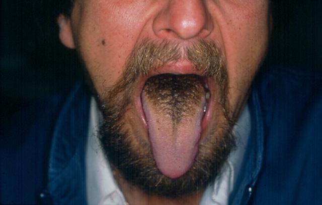 MUCOSAL LESIONS - Black Hairy Tongue