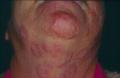 SUPERFICIAL FUNGAL INFECTIONS - Tinea faciale