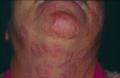 SUPERFICIAL FUNGAL INFECTIONS - Tinea faciale