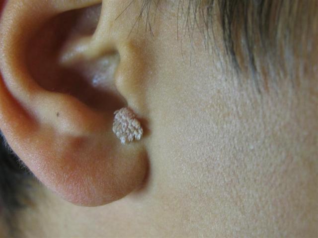 infected plantar wart !!!!!!!!!!!!!!!!? | Yahoo Answers