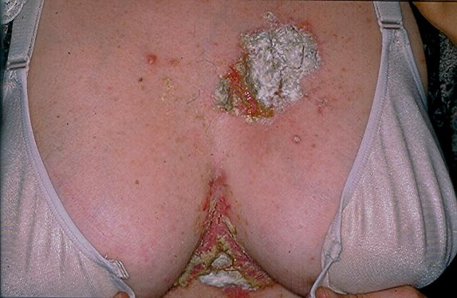 GENODERMATOSES - Hailey-Hailey disease