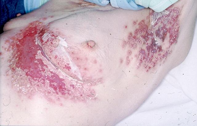 BULLOUS DISEASES - Pemphigus Vulgaris BULLOUS DISEASES - Pemphigus Vulgaris