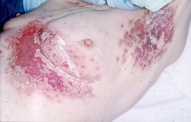 BULLOUS DISEASES - Pemphigus Vulgaris