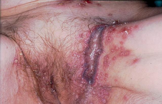 BULLOUS DISEASES - Pemphigus Vulgaris BULLOUS DISEASES - Pemphigus Vulgaris