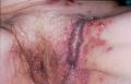 BULLOUS DISEASES - Pemphigus Vulgaris