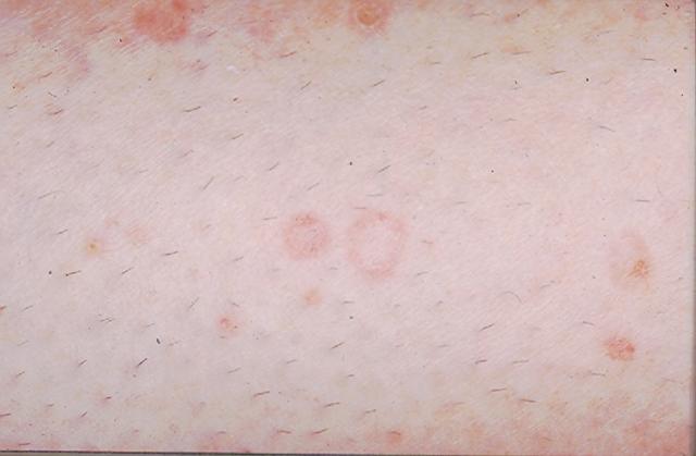 KERATINISATION DISORDERS - Porokeratosis of Mibelli KERATINISATION DISORDERS - Porokeratosis of Mibelli