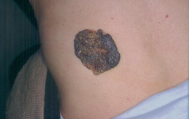 BENIGN SKIN LESIONS, NEVI, CYSTS - Seborrheic keratosis