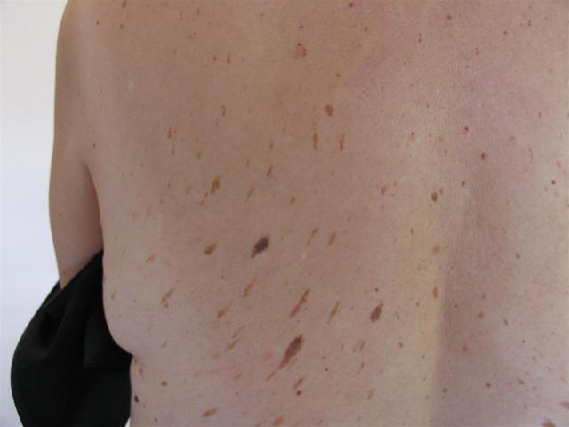 BENIGN SKIN LESIONS, NEVI, CYSTS - Seborrheic keratosis