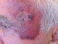 DRUG ERUPTIONS - Ecchymoses due to topical corticosteroids