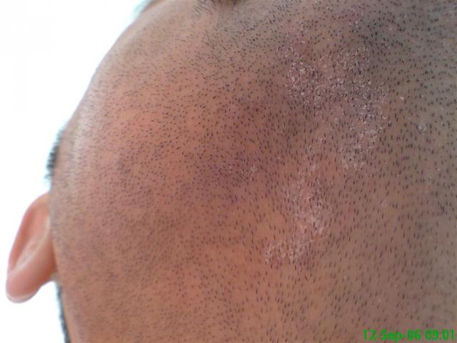 DERMATITIS - EKZEMA - Seborrheic Dermatitis