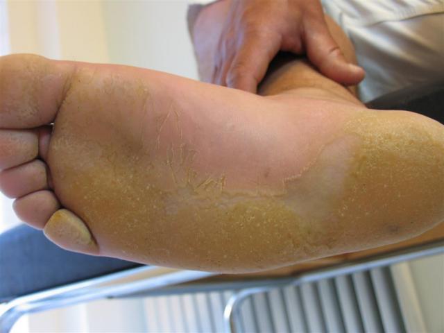 BACTERIAL INFECTIONS - Pitted keratolysis BACTERIAL INFECTIONS - Pitted keratolysis