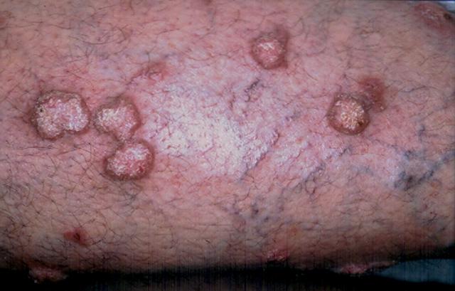 Lichen Planus Hypertrophic - Dermatology Education