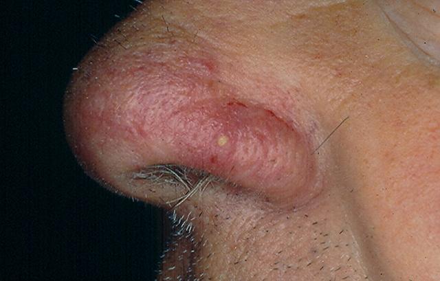 PARASITOSES, BITES - Democidosis - Rosacea like