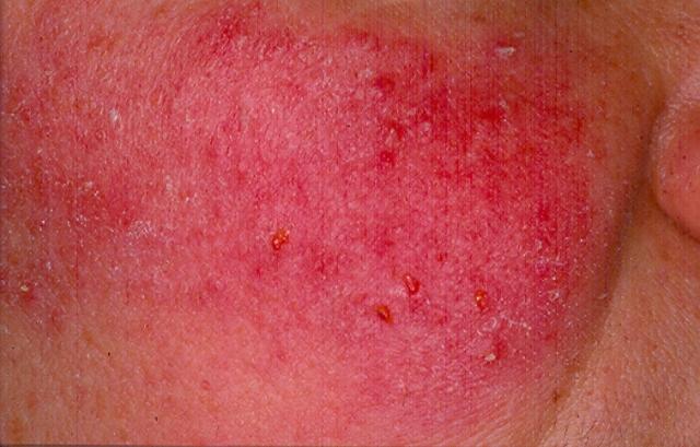 PARASITOSES, BITES - Democidosis - Rosacea like PARASITOSES, BITES - Democidosis - Rosacea like