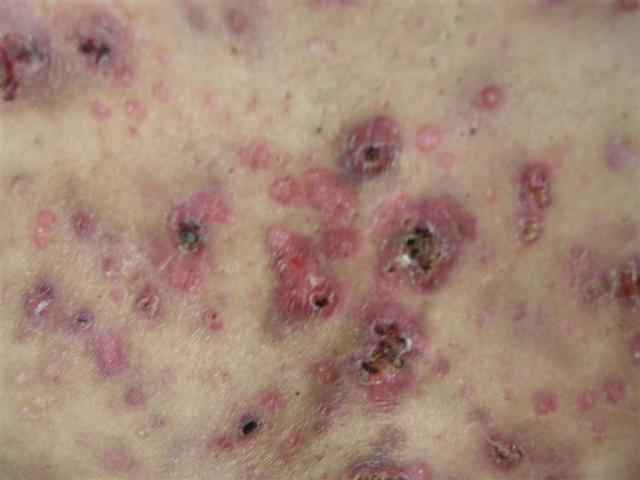 DISEASES OF THE SEBACEOUS GLANDS - Necrotic Acne DISEASES OF THE SEBACEOUS GLANDS - Necrotic Acne