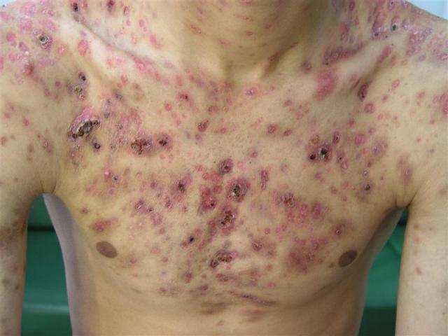 DISEASES OF THE SEBACEOUS GLANDS - Necrotic Acne DISEASES OF THE SEBACEOUS GLANDS - Necrotic Acne