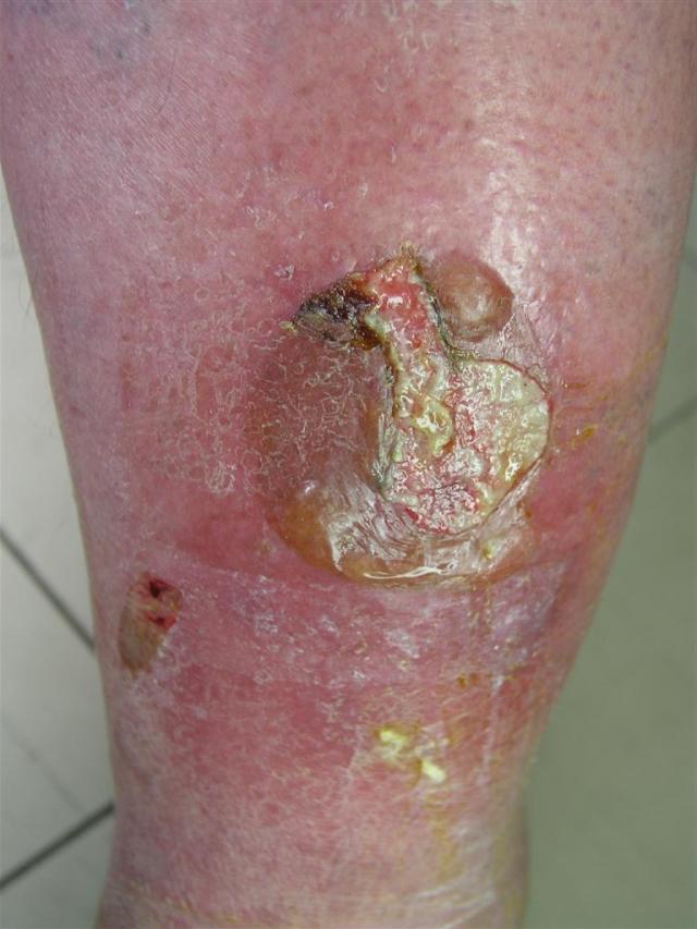 diabetes skin lesions