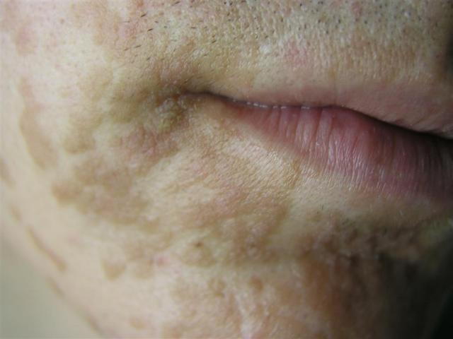 GENODERMATOSES - Epidermodysplasia Verruciformis (Lewandowsky-Lutz dysplasia)