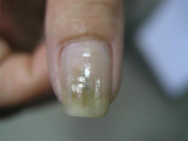 NAIL DISEASES - Pseudomonas aeruginosa infection of the nail NAIL DISEASES - Pseudomonas aeruginosa infection of the nail