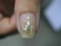 NAIL DISEASES - Pseudomonas aeruginosa infection of the nail