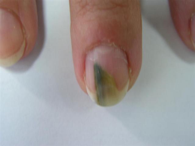 NAIL DISEASES - Pseudomonas aeruginosa infection of the nail